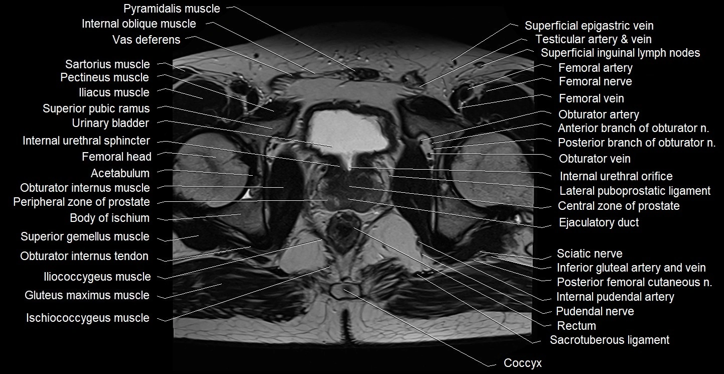 Male pelvis axial cross sectional anatomy image 30.webp